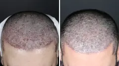 Saç Ekimi Fiyatları 2026 Tarifesi Belli Oldu: Greft Başına Ücret Hesaplama ve En İyi Merkezler Listesi - Gtmd